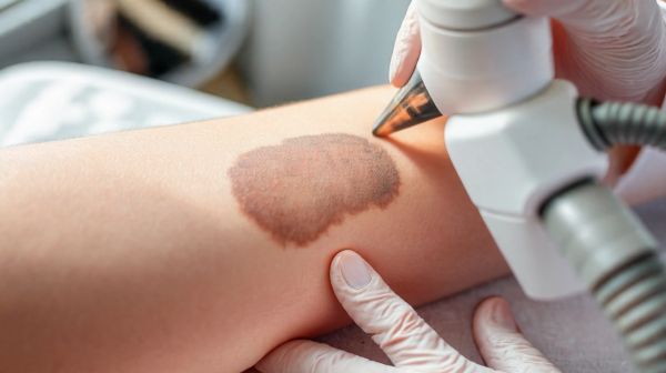 Meilleures méthodes pour effacer un tatouage à Lyon